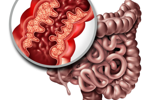 Symptoms and treatment options for Crohn's Disease and Inflammation of the Digestive Tract