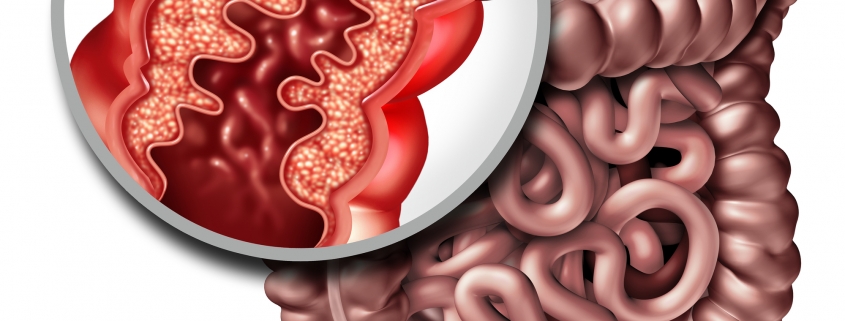 Symptoms and treatment options for Crohn's Disease and Inflammation of the Digestive Tract